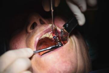 Zabiegi chirurgii periodontolgicznej minimalizują ryzyko utraty zębów - ATJ Stomatologia Zabiegi chirurgii periodontolgicznej minimalizują ryzyko utraty zębów - ATJ Stomatologia