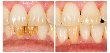 czyszczenie zębów łódź, skaling , piaskowanie, wybielanie zębów łódź, periodontolog łódź, stomatolog łódź, dentysta łódź, klinika stomatologiczna łódź