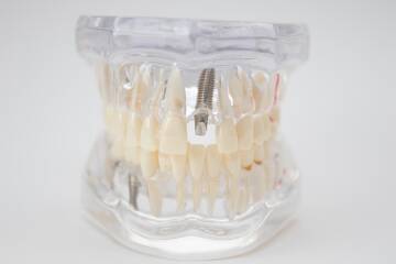 Implanty dentystyczne wspierają zdrowie kości i dziąseł. poprawa-zdrowia-jamy-ustnej-po-zastosowaniu-implantow-zebowych-\atj-stomatologia-lodz