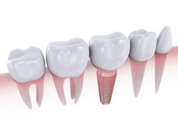 implanty łódź, stomatolog łódź, chirurg szczękowy łódź, endodonta łódź, periodontolog łódź, ortodonta łódź, klinika stomatologiczna, RTG pantomograficzne, RTG zęba, mosty protetyczne, protetyk łódź'�&#