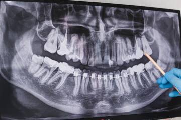 leczenie-osemek-atj-stomatologia leczenie-osemek-atj-stomatologia