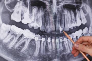 poznaj-objawy-wskazujace-na-koniecznosc-endodoncji-leczenia-kanalowego-zęba-atj-stomatologia-lodz poznaj-objawy-wskazujace-na-koniecznosc-endodoncji-leczenia-kanalowego-zęba-atj-stomatologia-lodz
