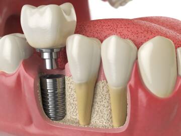 Co to sa implanty dentystyczne? ATJ Stomatologia Co to sa implanty dentystyczne? ATJ Stomatologia